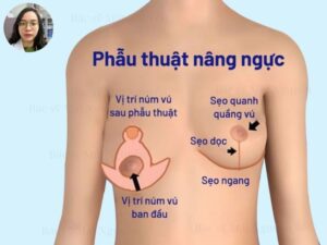 Phẫu thuật ngực