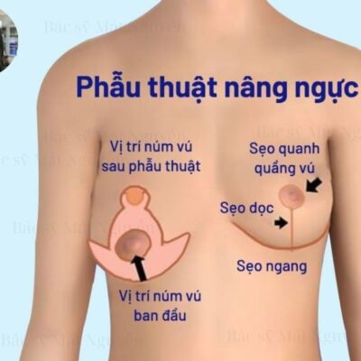 Phẫu thuật ngực