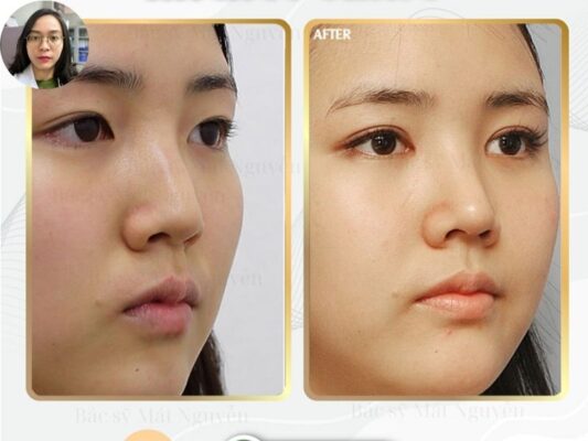 Phẫu thuật cắt mí mini deep