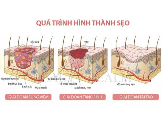 Quá trình hình thành sẹo lồi