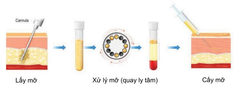 các giai đoạn cấy mỡ